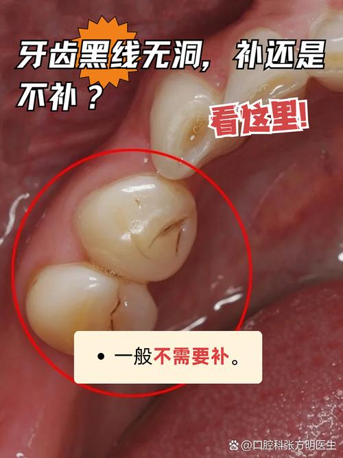 牙缝为什么会变黑