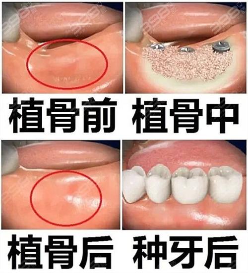 什么是植骨手术