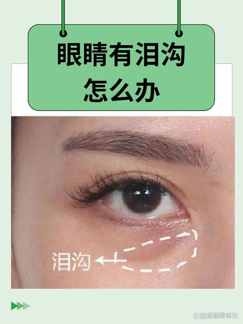 为什么会长泪沟