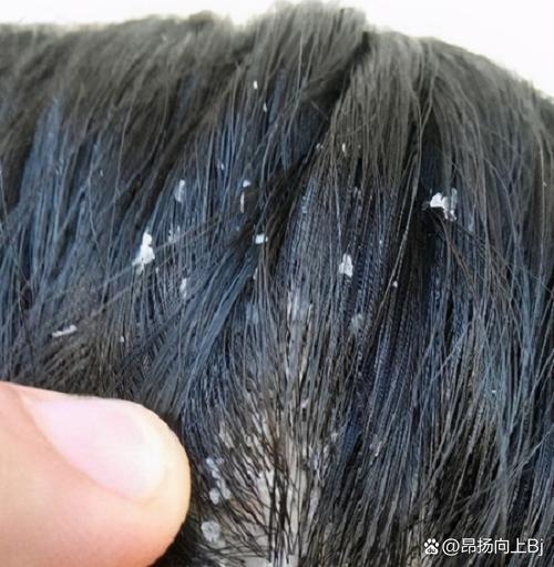 头癣有什么症状