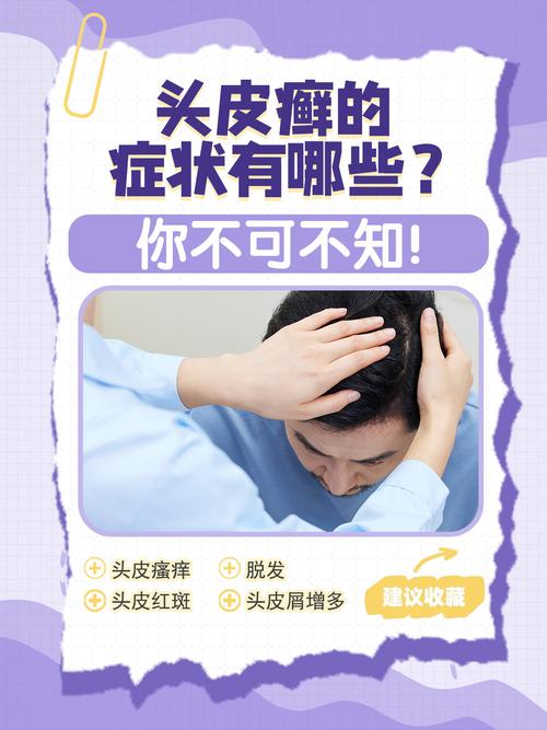 头癣有什么症状