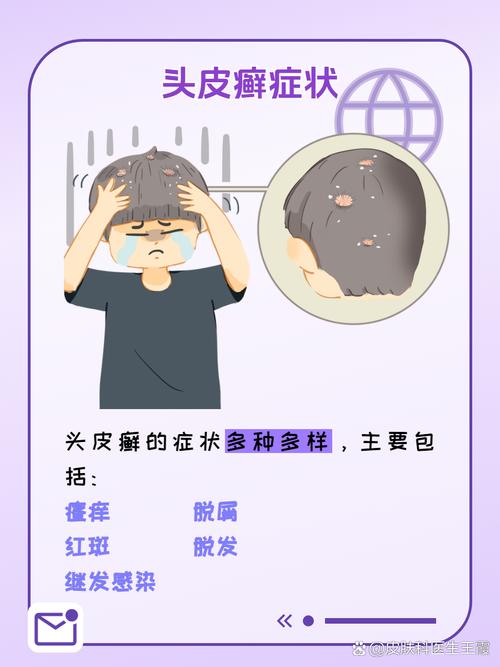 头癣有什么症状