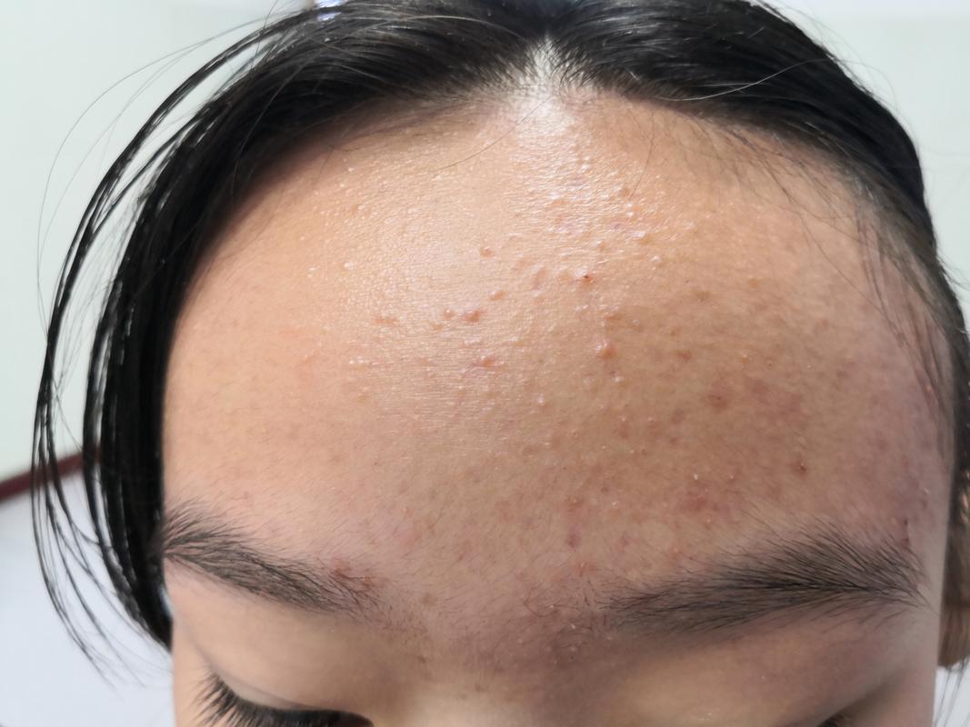 青春痘里面是什么