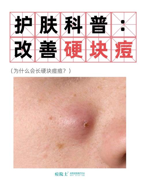 青春痘里面是什么