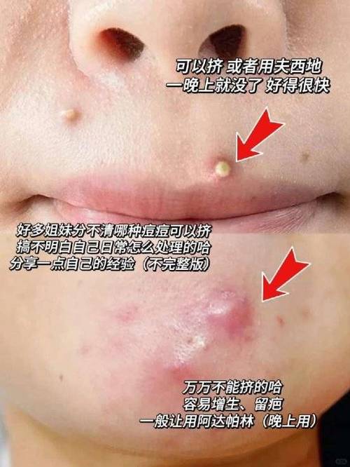 青春痘里面是什么