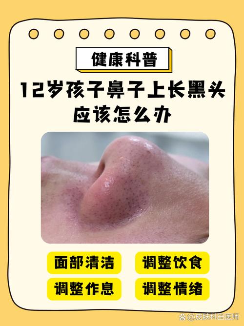 鼻子为什么会长黑头