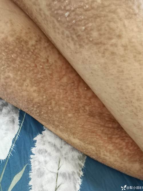 身上长黑斑是什么病