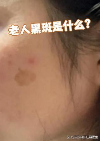身上长黑斑是什么病