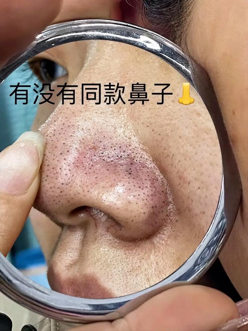 为什么鼻子会长黑头