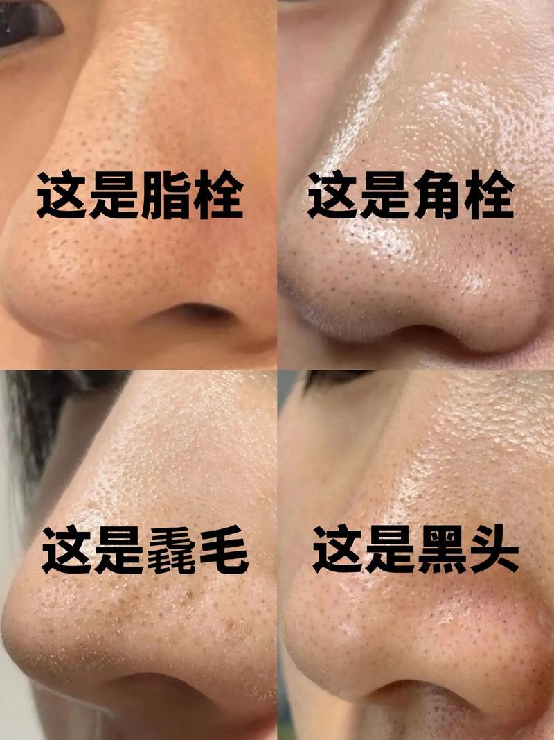 为什么鼻子会长黑头