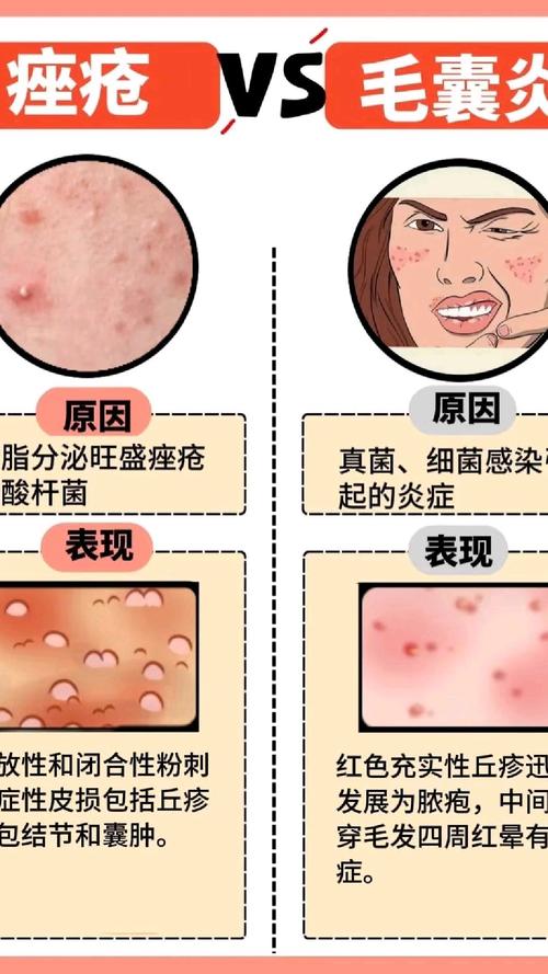 痘痘为什么会发炎