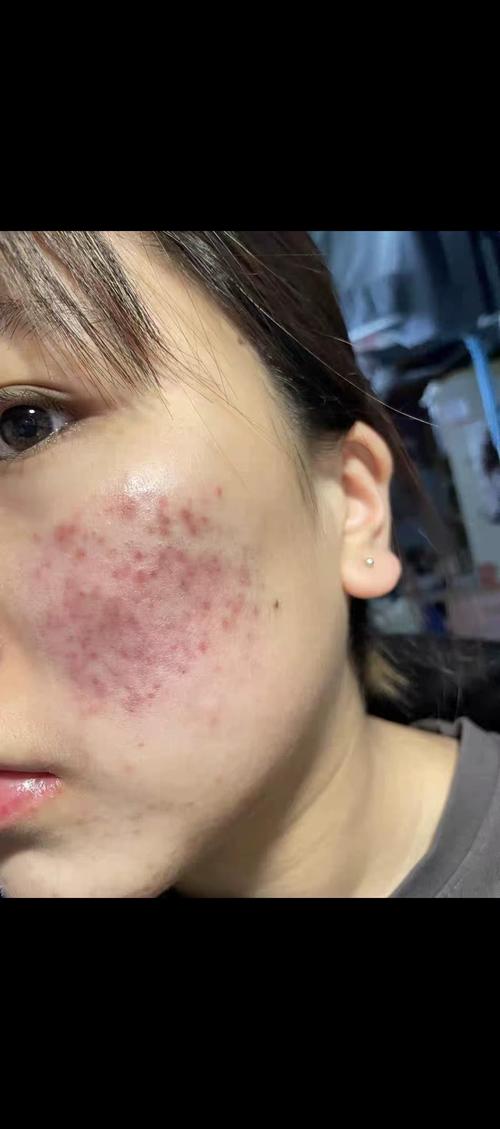 洗面奶洗完脸上起痘痘怎么回事