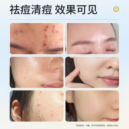 洗面奶洗脸祛痘怎么样