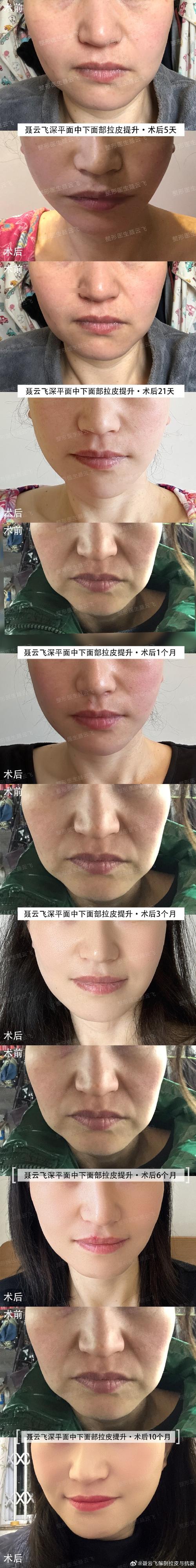 减肥后脸为什么松了怎么办