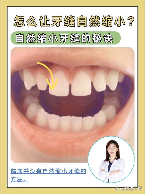 牙缝大有什么办法