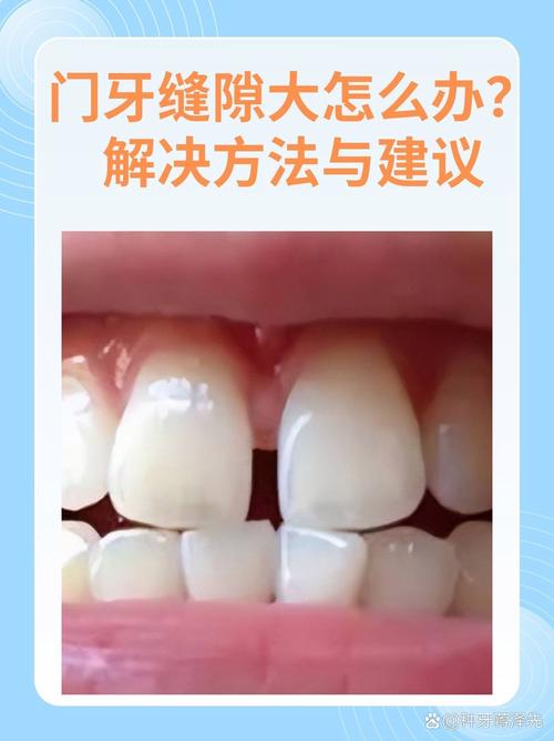 牙缝大有什么办法