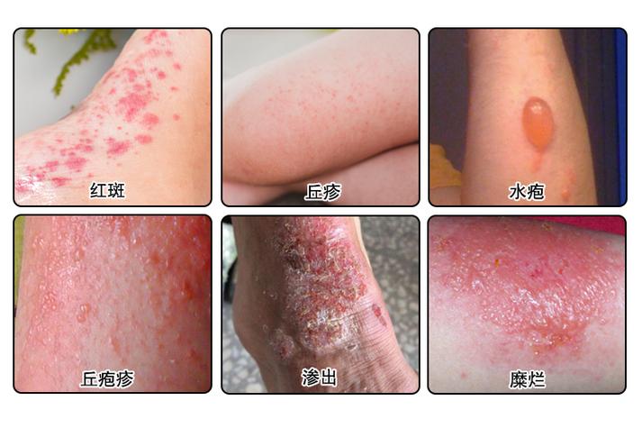 湿疹都有什么症状