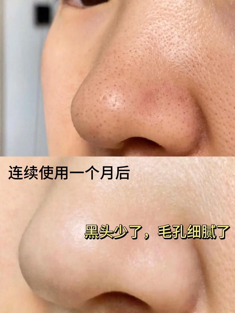 用洗面奶 黑头还在怎么办