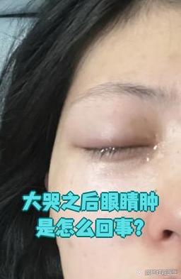 哭完为什么眼睛会肿