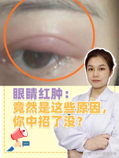 哭完为什么眼睛会肿