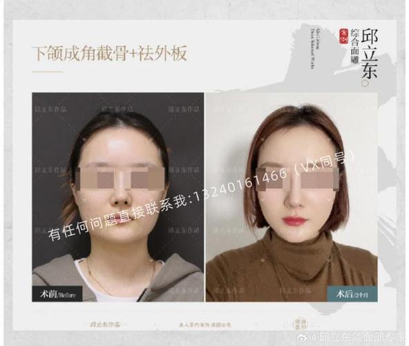 削骨有什么后遗症