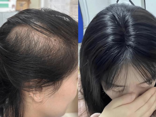 为什么头发越来越细