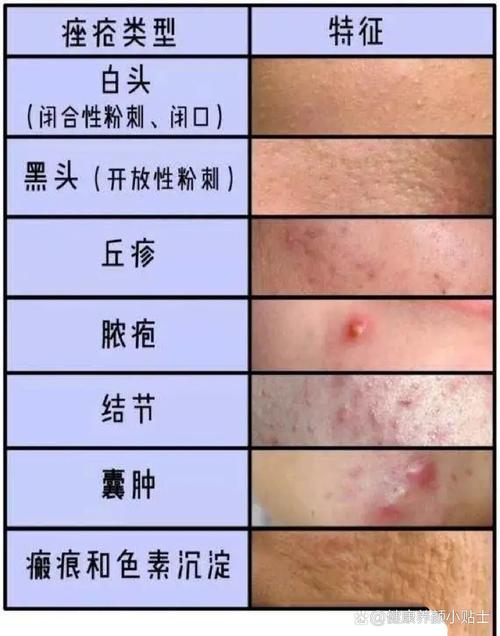 青春期为什么会长痘