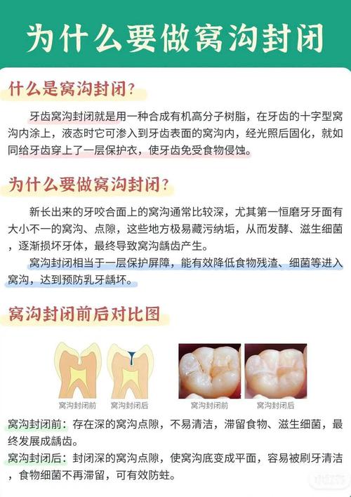 什么时候做窝沟封闭