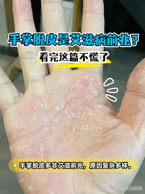手部脱皮是什么原因