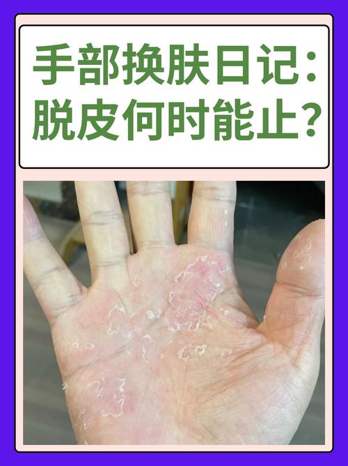 手部脱皮是什么原因