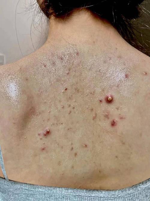 背上起疙瘩什么原因
