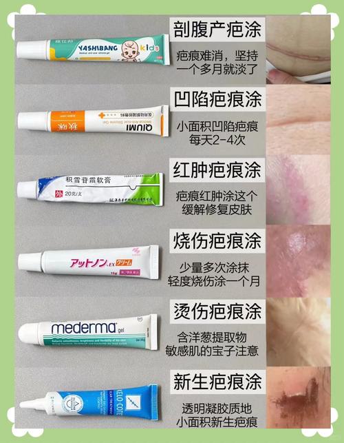 疤痕膏什么牌子好