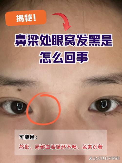 眼眶发黑是什么病