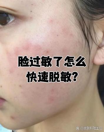 脸用洗面奶过敏怎么办