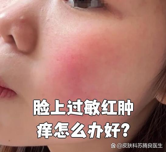 脸用洗面奶过敏怎么办