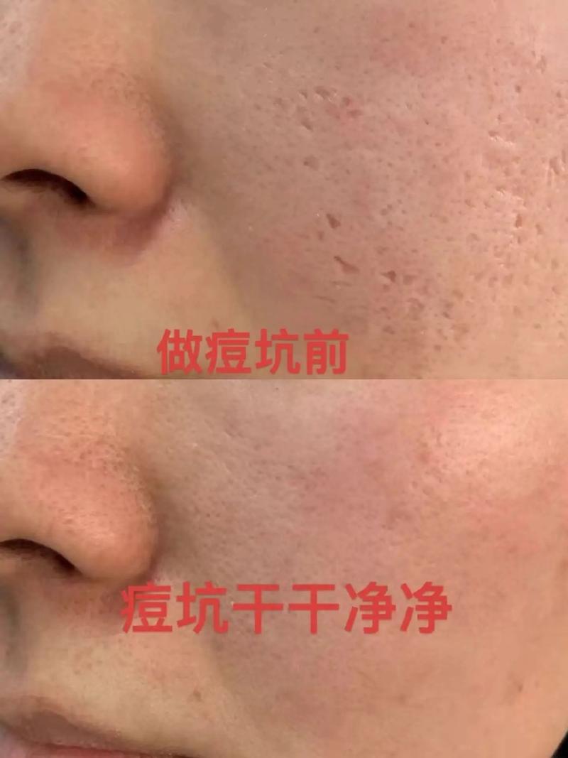 痘印痘坑做什么医美