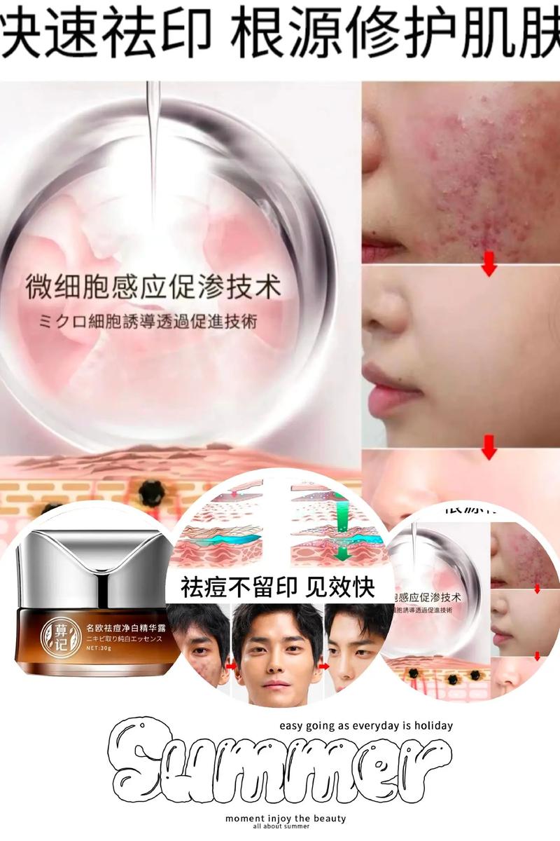 痘印痘坑做什么医美