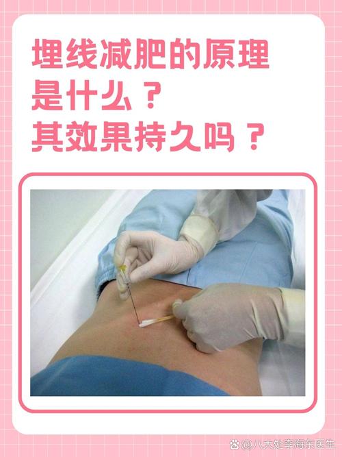 什么是埋线减肥法图片