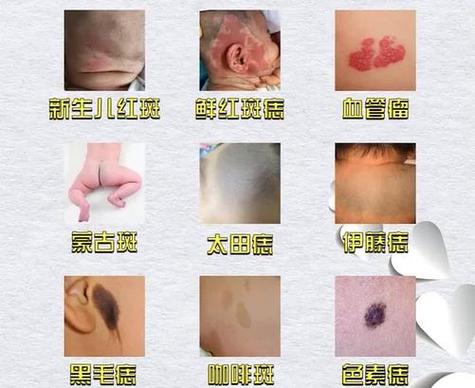 为什么宝宝会有胎记