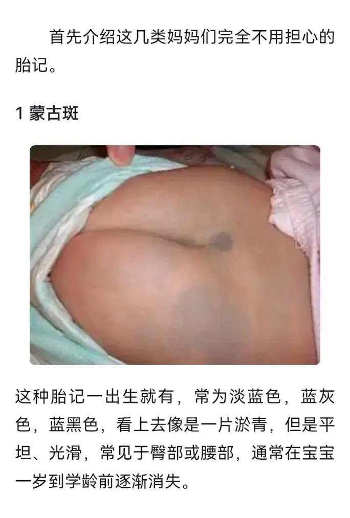 为什么宝宝会有胎记