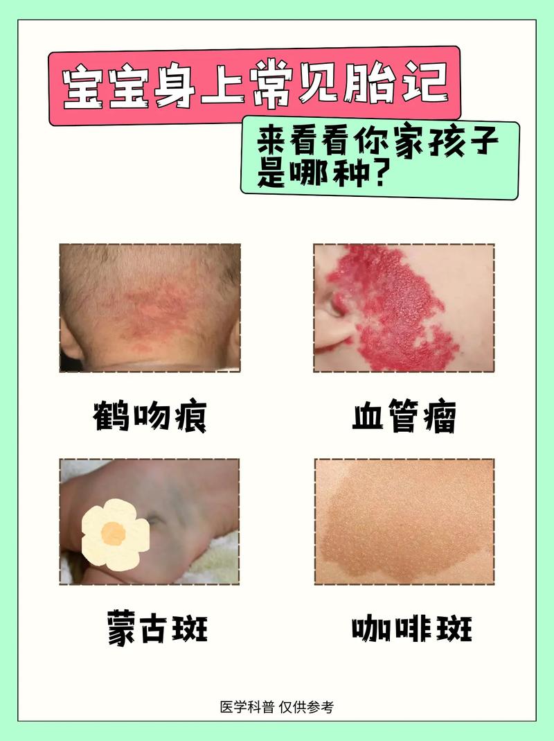 为什么宝宝会有胎记
