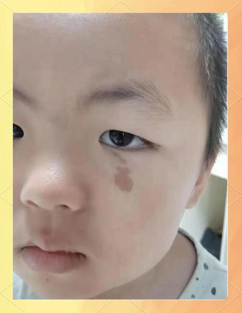 宝宝为什么会有胎记