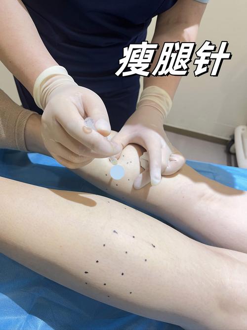 瘦小腿打什么针