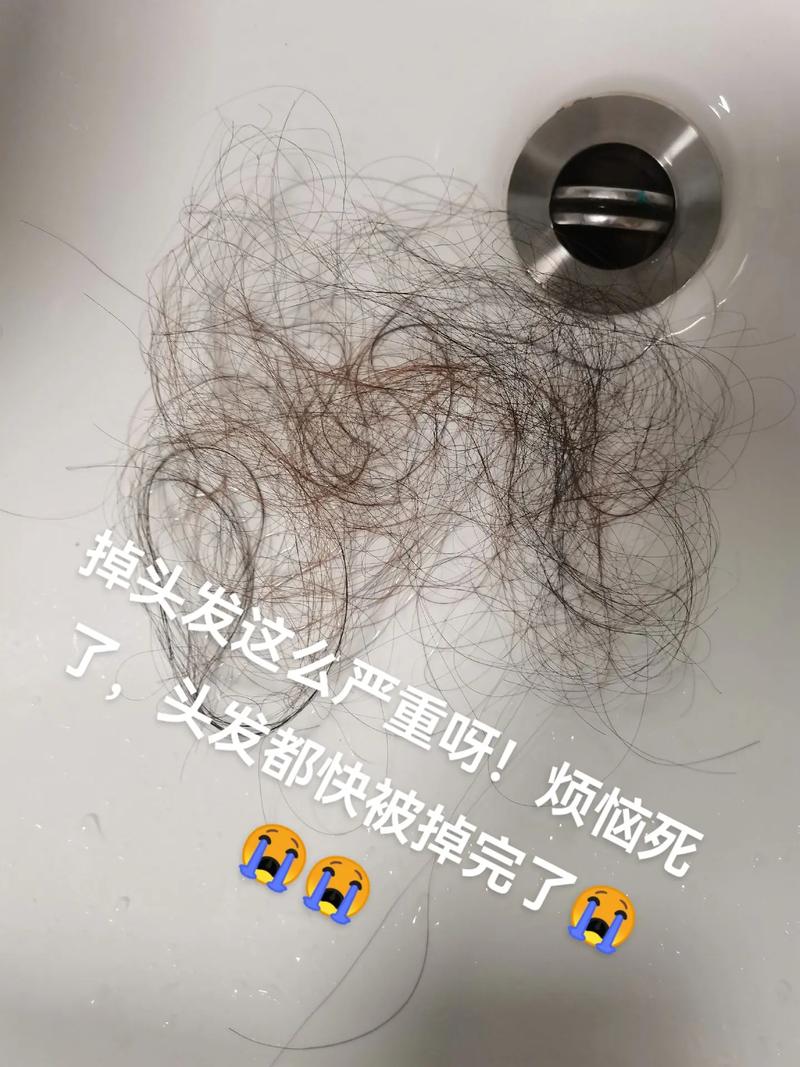 头发脱落是什么病