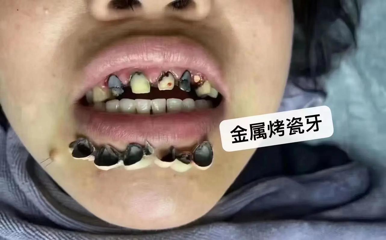 烤瓷牙不能吃什么