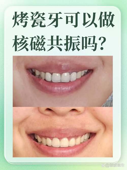 烤瓷牙不能吃什么