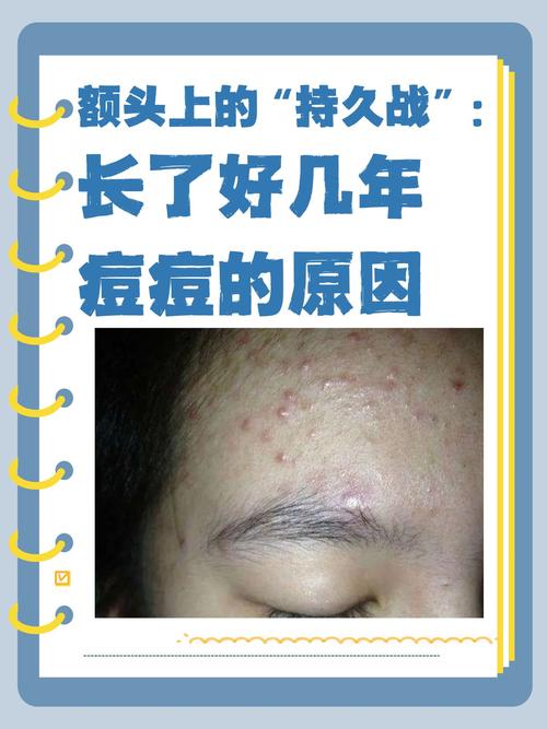 脑门起痘痘什么原因