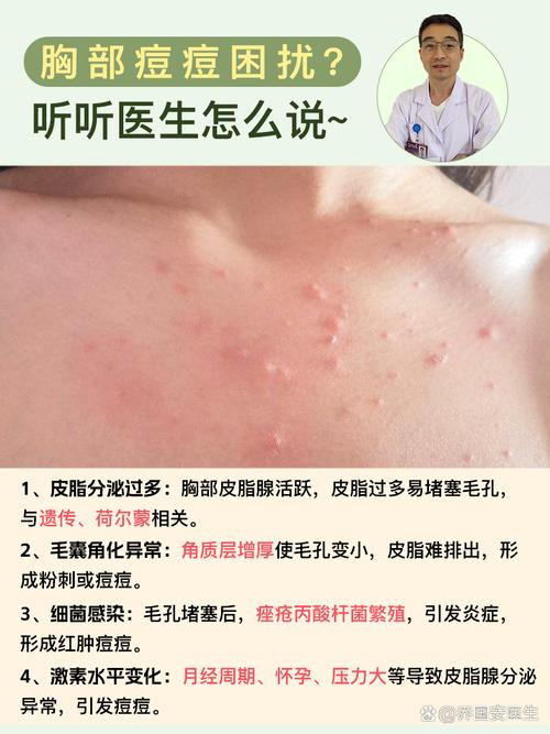 胸口为什么会长痘痘