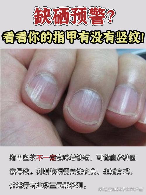 指甲为什么长竖纹