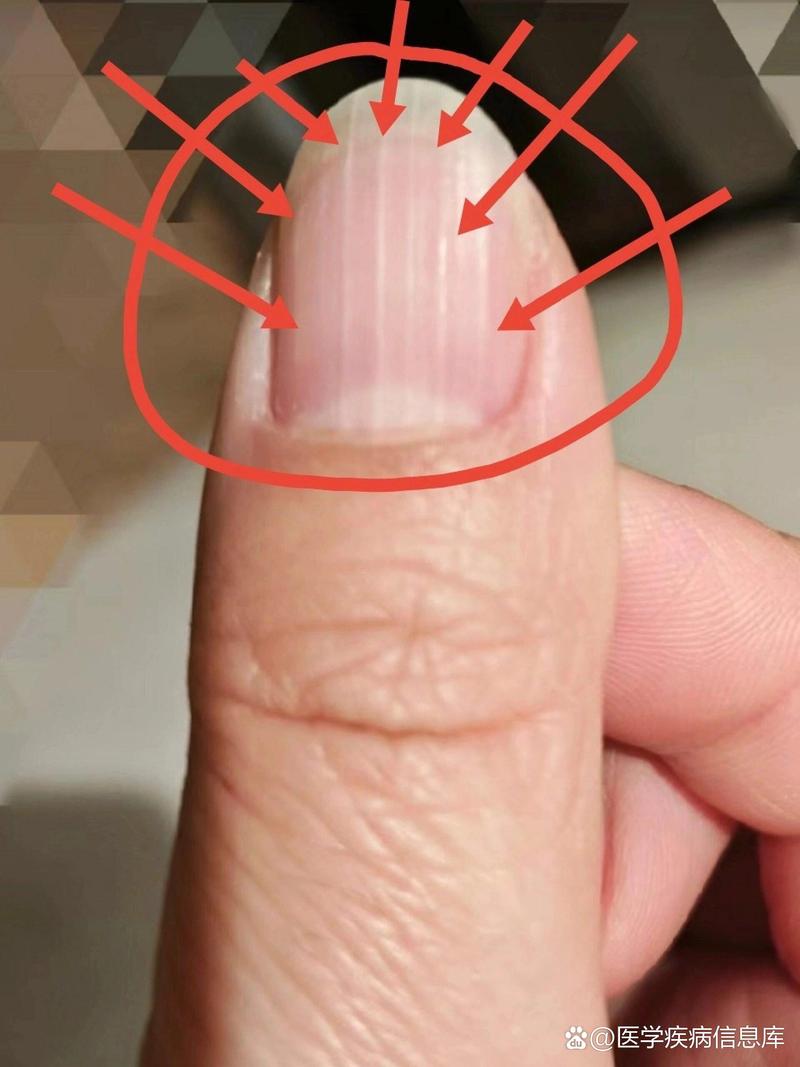 指甲为什么长竖纹